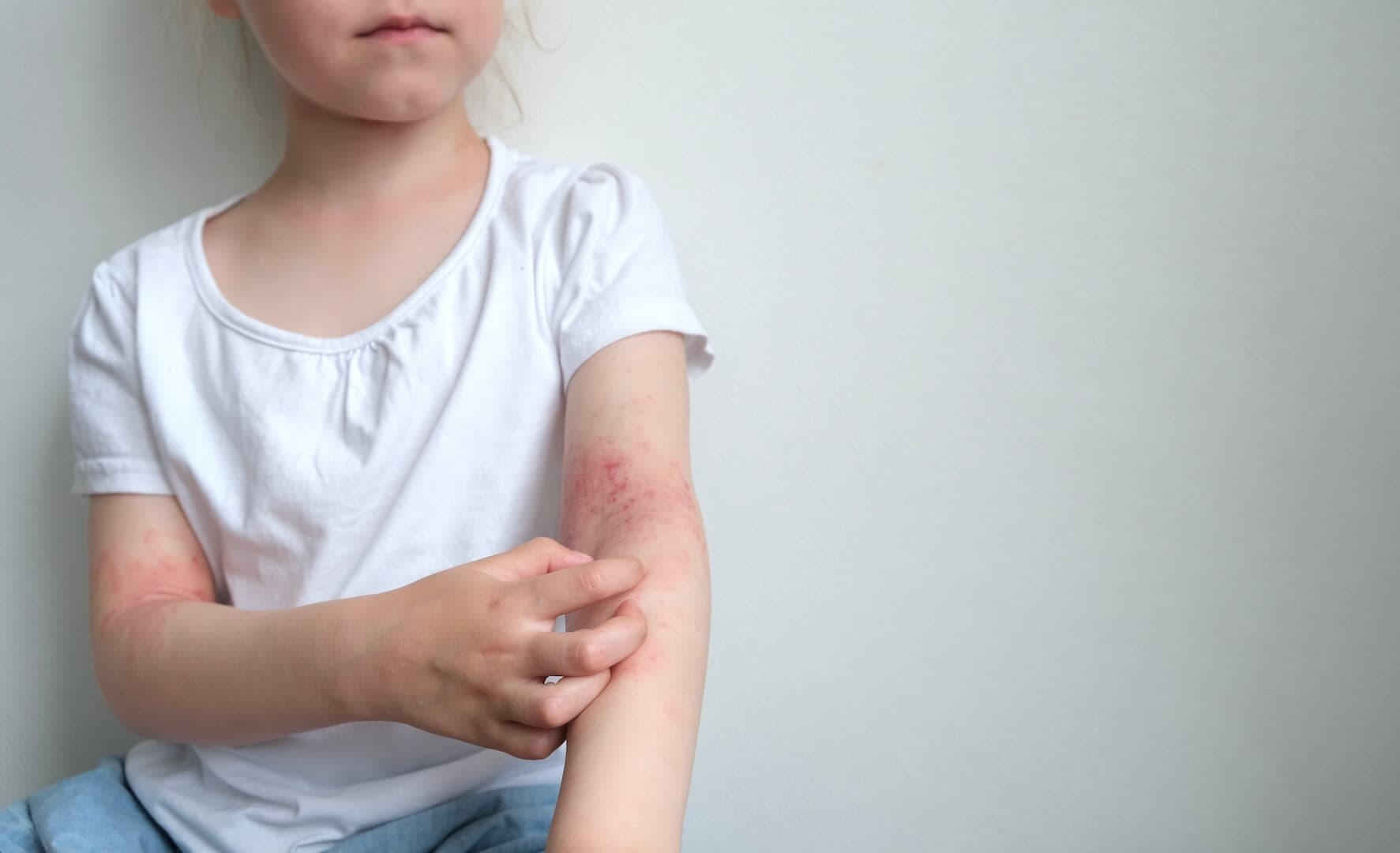 Female white child in a white top, with redness on her inner elbow, scratching herself due to apparent discomfort
